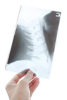 spinal decompression therapy