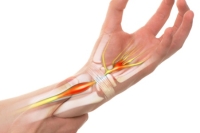 Chiropractic Care Can Help Manage Carpal Tunnel Syndrome